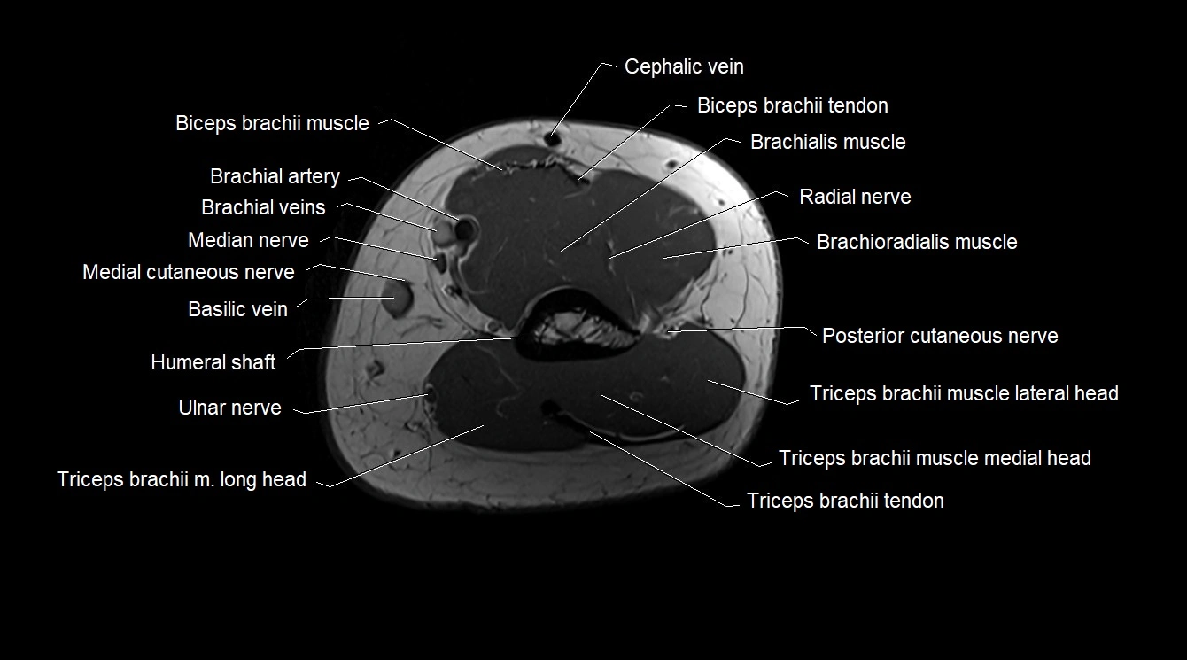Upper arm( humerus) cross section anatomy MRI 3T axial image 48.webp